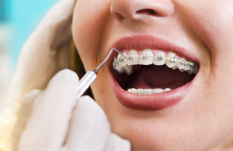 Ortodonti Orthodontics SimyaDent