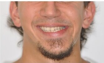 Yüz asimetrisi Simyadent Diş Tedavisi Ortodonti Şeffaf Plak implant